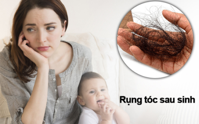 rụng tóc sau sinh