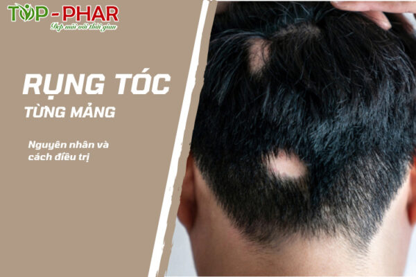 rụng tóc từng mảng